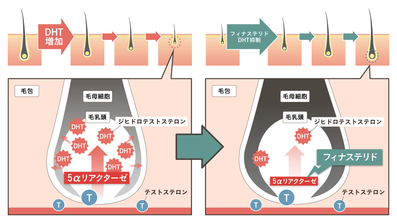 http://フィナステリド