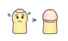 仮性包茎の画像
